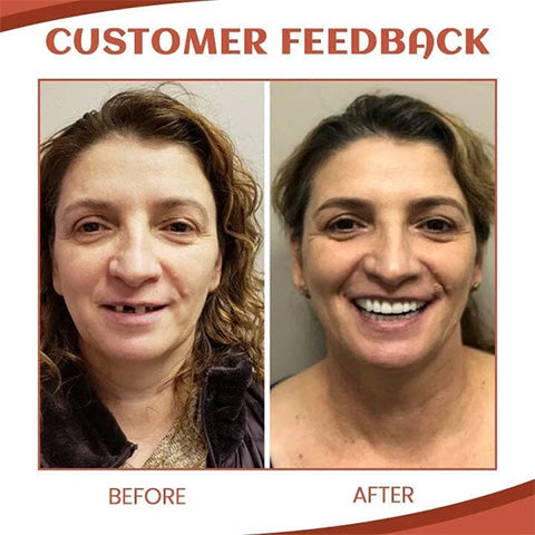 SecureSmile™ – Sécurité sans douleur et maintien ferme pour votre dentier [50 % de réduction]