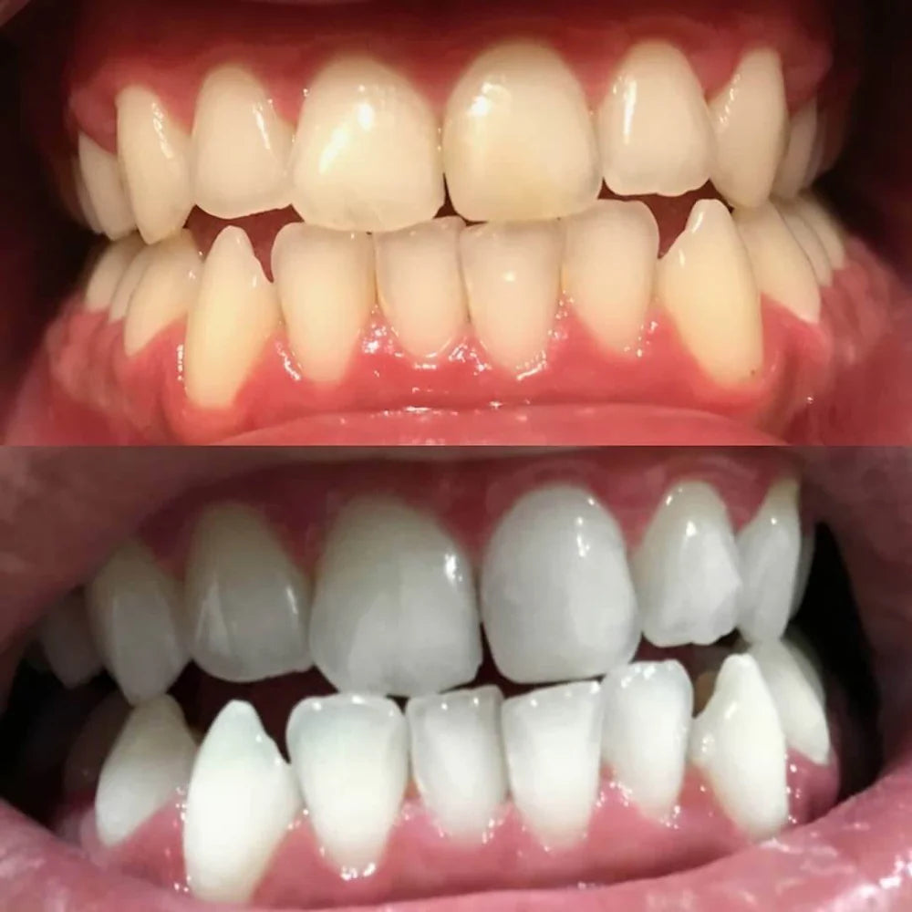 WhiteBoost™ – Rayonnez avec un Sourire qui Illumine Toute la Pièce [1 + 1 Gratuit]