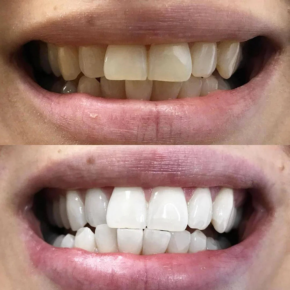 WhiteBoost™ – Rayonnez avec un Sourire qui Illumine Toute la Pièce [1 + 1 Gratuit]