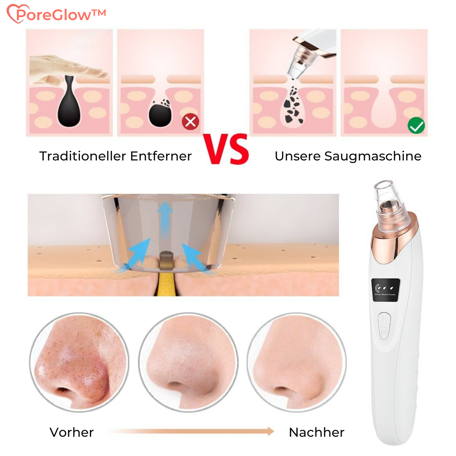 Aspirateur de Points Noirs à Vide avec 5 Embouts pour Visage
