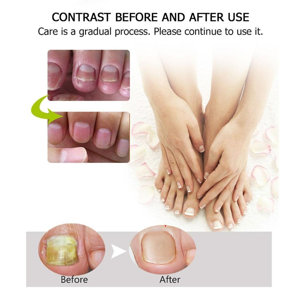 Soin Fortifiant pour Ongles – Gel Réparateur contre les Mycoses
