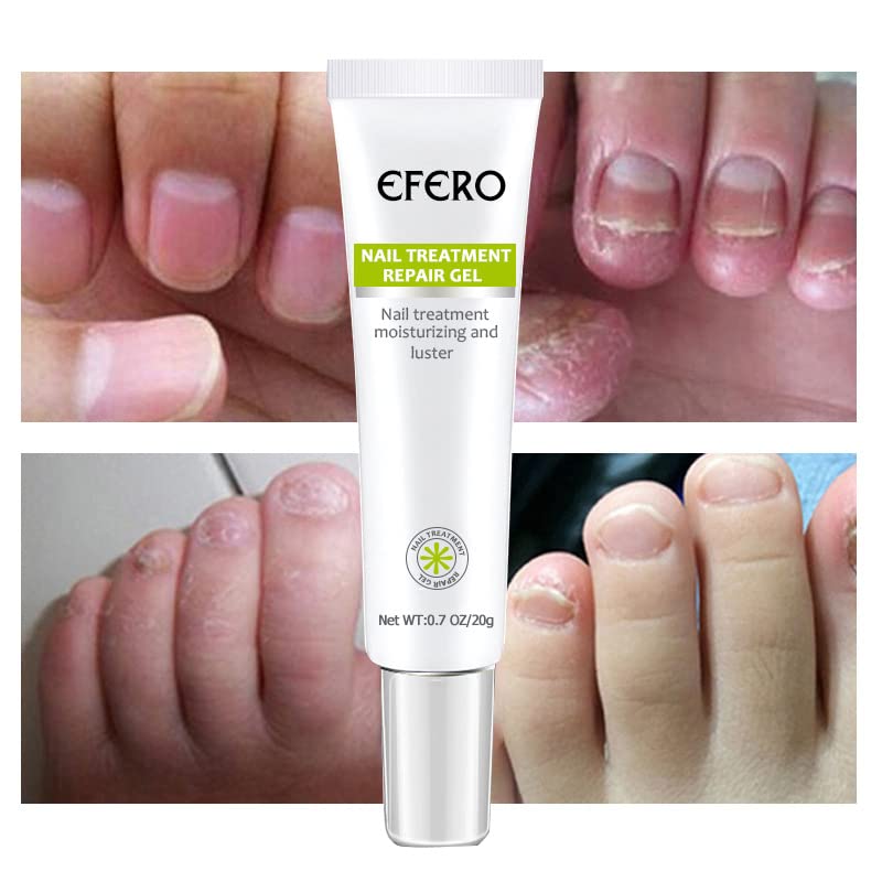 Soin Fortifiant pour Ongles – Gel Réparateur contre les Mycoses