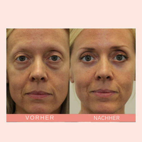 jugendlicherbalken™ – Pour un contour des yeux lisse, éclatant et d’apparence jeune [1 + 1 Gratuit]