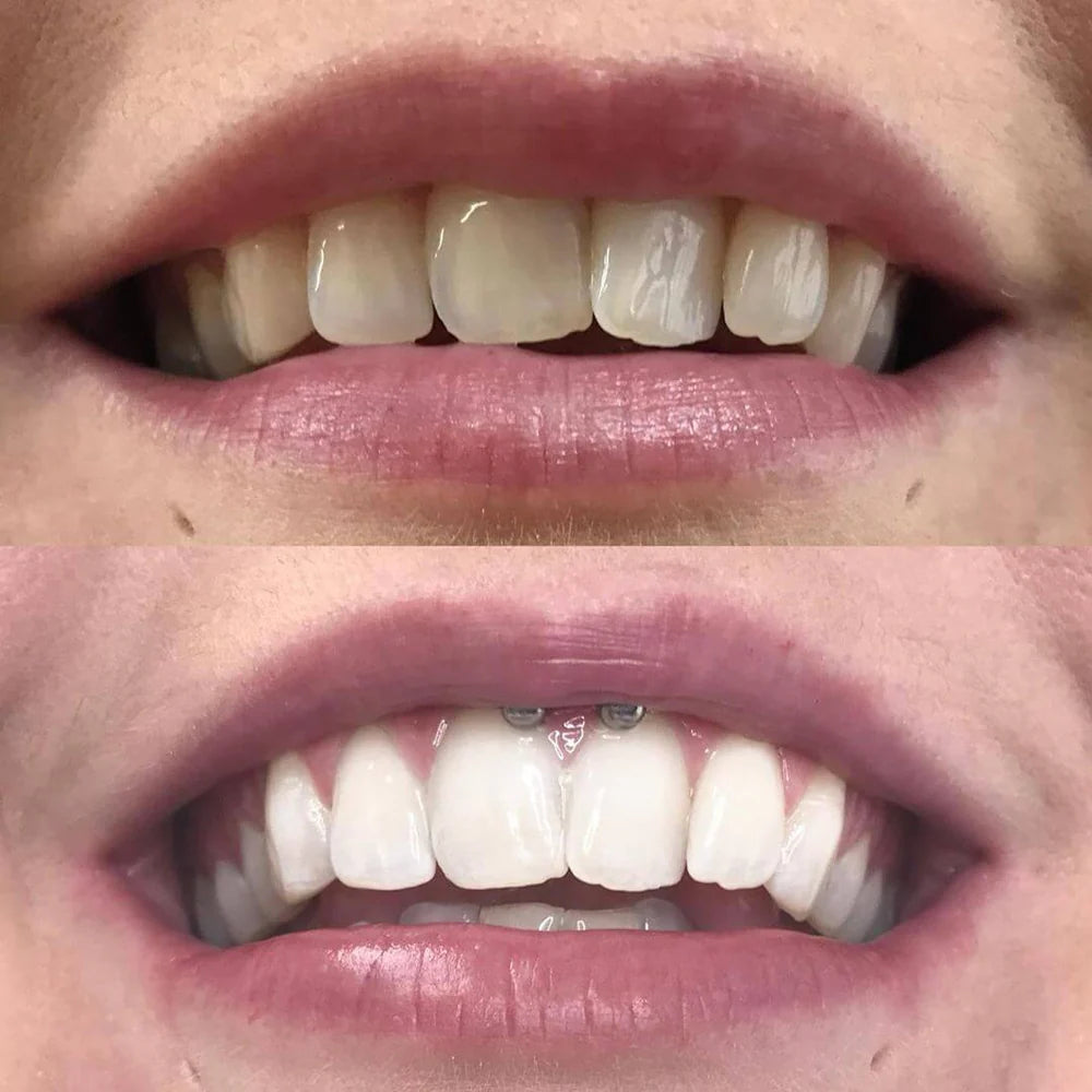 WhiteBoost™ – Rayonnez avec un Sourire qui Illumine Toute la Pièce [1 + 1 Gratuit]