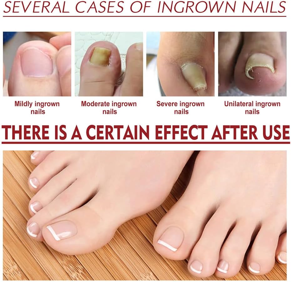HealDrop™ – Répare les ongles abîmés en 4 semaines [1 + 1 Gratuit]