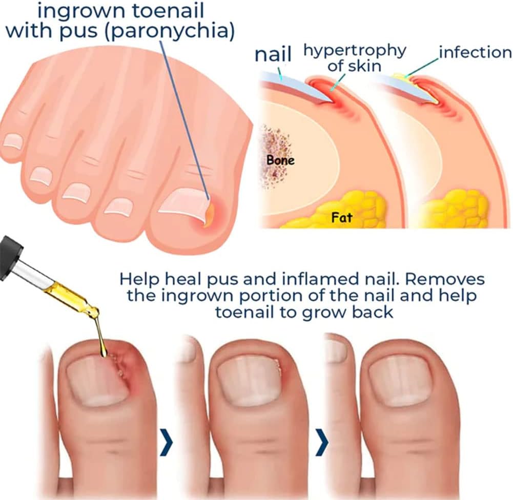 HealDrop™ – Répare les ongles abîmés en 4 semaines [1 + 1 Gratuit]