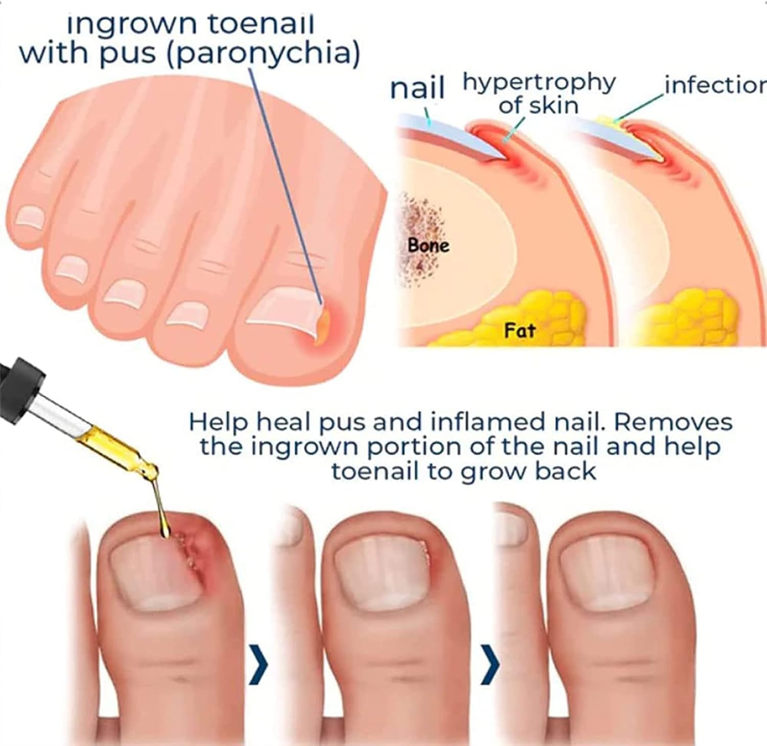 Sérum Intensif Nourrissant pour Ongles des Pieds et des Mains