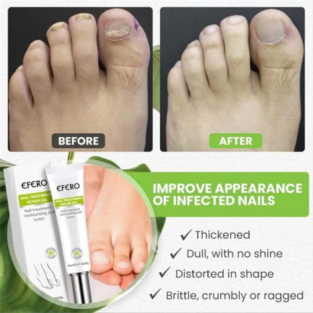 RejuveNail™ – Renforce Durablement des Ongles Sains & Élégants [1 + 1 Gratuit]