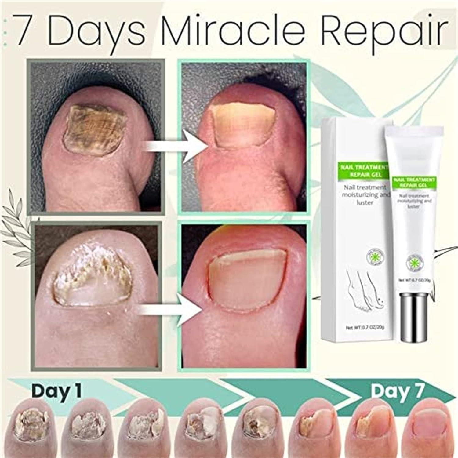RejuveNail™ – Renforce Durablement des Ongles Sains & Élégants [1 + 1 Gratuit]