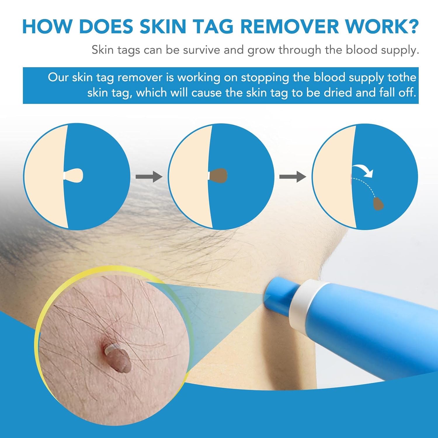 DermaFix™ – Kit avancé pour l’élimination des verrues [1 + 1 Gratuit]
