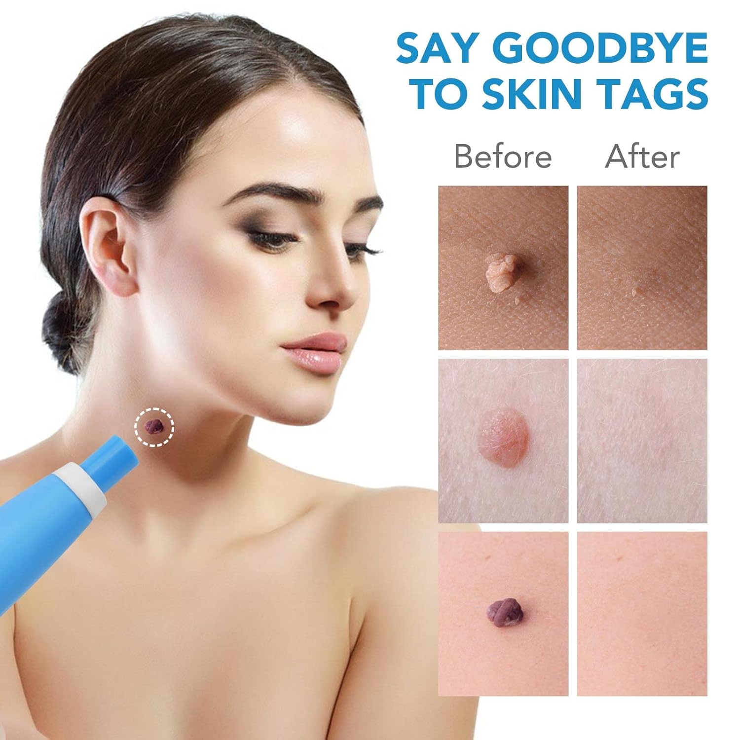 DermaFix™ – Kit avancé pour l’élimination des verrues [1 + 1 Gratuit]
