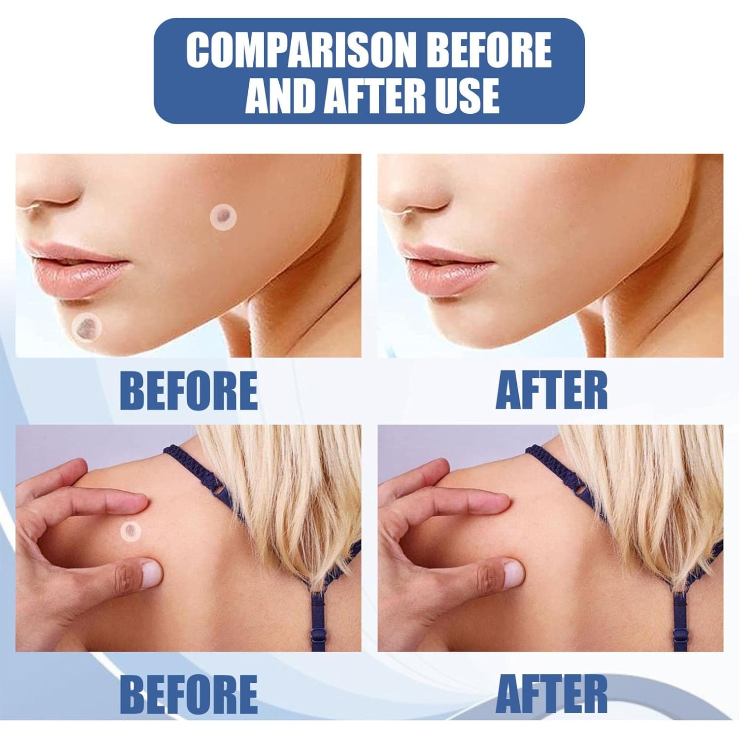 DermaFix™ – Kit avancé pour l’élimination des verrues [1 + 1 Gratuit]