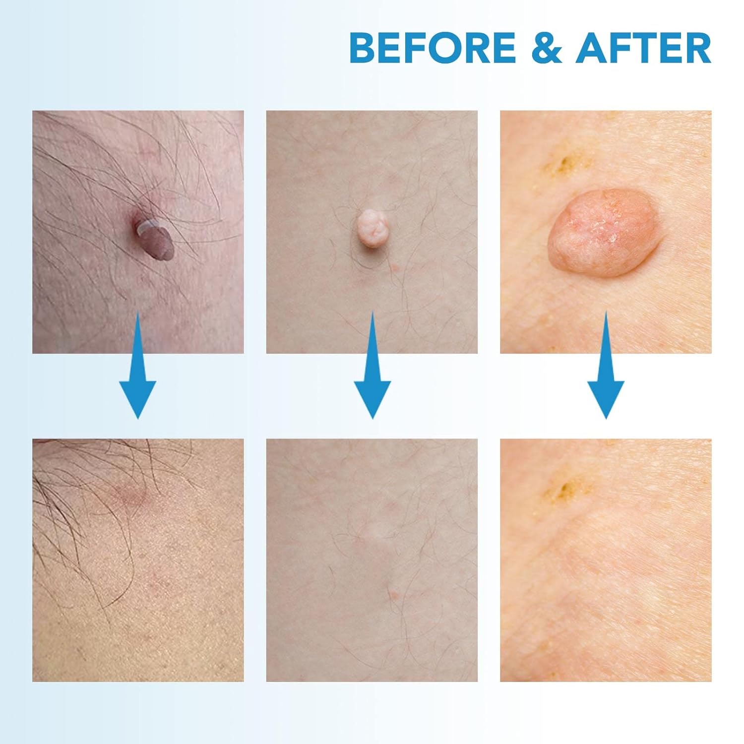 DermaFix™ – Kit avancé pour l’élimination des verrues [1 + 1 Gratuit]