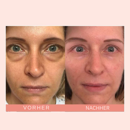 jugendlicherbalken™ – Pour un contour des yeux lisse, éclatant et d’apparence jeune [1 + 1 Gratuit]
