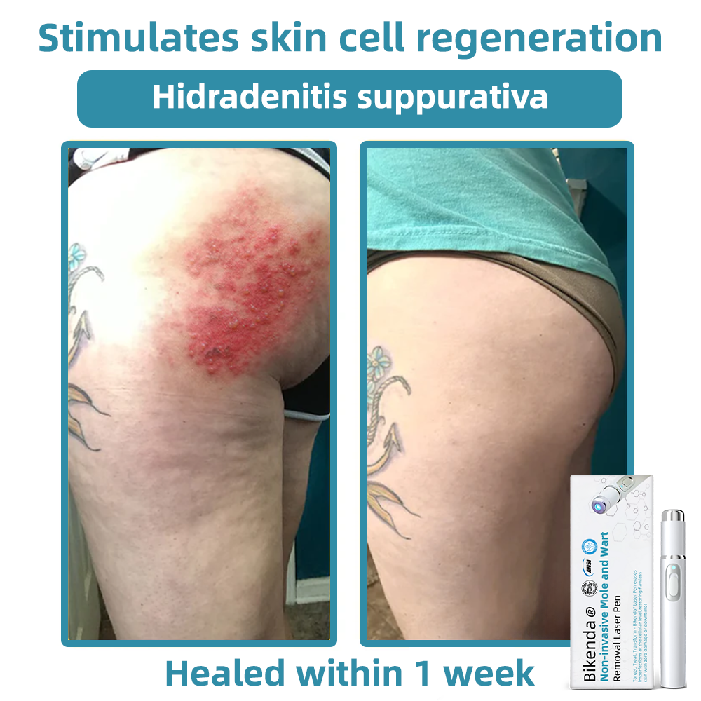 LumiRaze™ – Élimine Rapidement les Imperfections Cutanées et Apporte une Confiance Éclatante [50 % de Réduction]