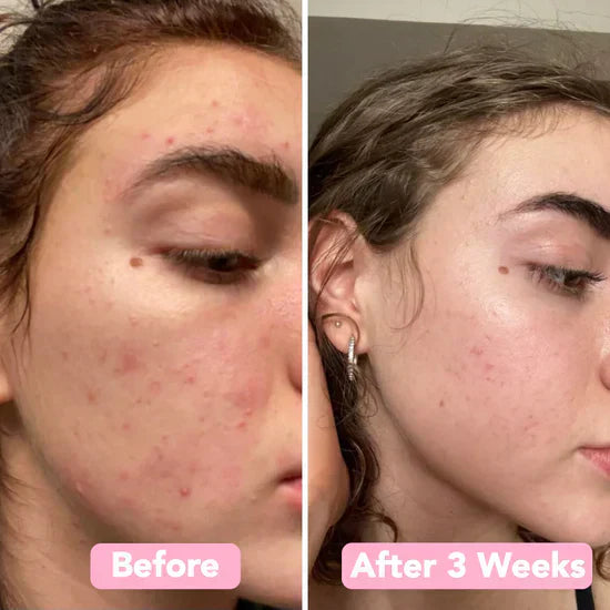 GlowPurify™ – Renouvellement Éclatant de la Peau & Nettoyage en Profondeur [50 % de Réduction]