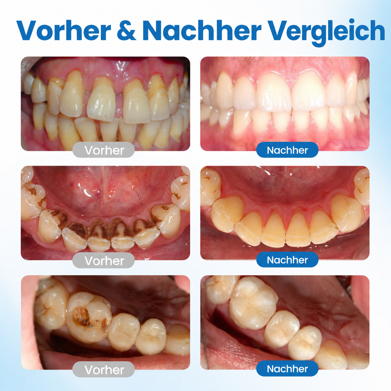 Sérum dentaire nano-hydroxyapatite pour émail et dents sensibles