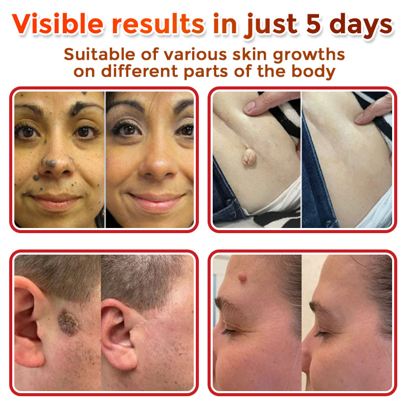 Micro-patchs anti-acrochordons à micro-aiguilles pour une peau lisse