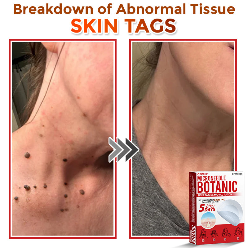 Micro-patchs anti-acrochordons à micro-aiguilles pour une peau lisse