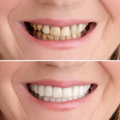Facettes Dentaires Thermoformables pour un Sourire Blanc et Éclatant