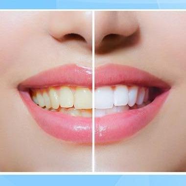 Stylo Blanchissant pour Dents – Blanchiment Doux & Efficace
