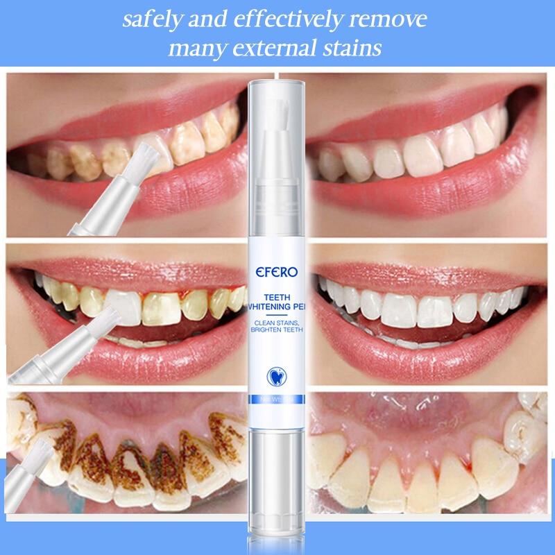 Stylo Blanchissant pour Dents – Blanchiment Doux & Efficace