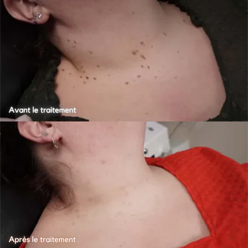 Sérum Soin Ciblé Excroissances Cutanées et Taches Pigmentaires
