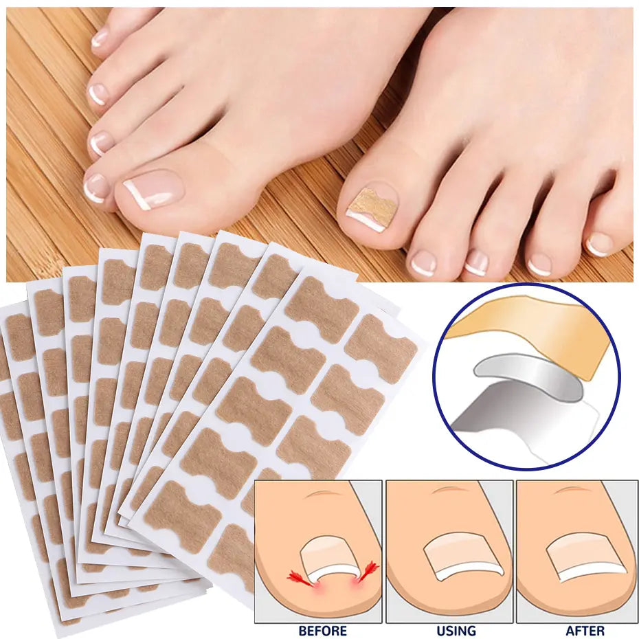 Correcteur d'Ongles Incarnés – Patchs de Redressement pour Pieds Soignés