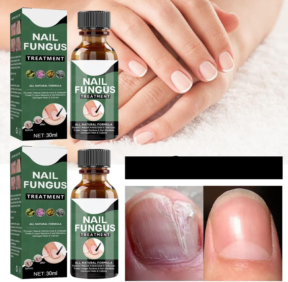 NagelPilz™ – Guérit, régénère et protège les ongles abîmés [1 + 1 Gratuit]