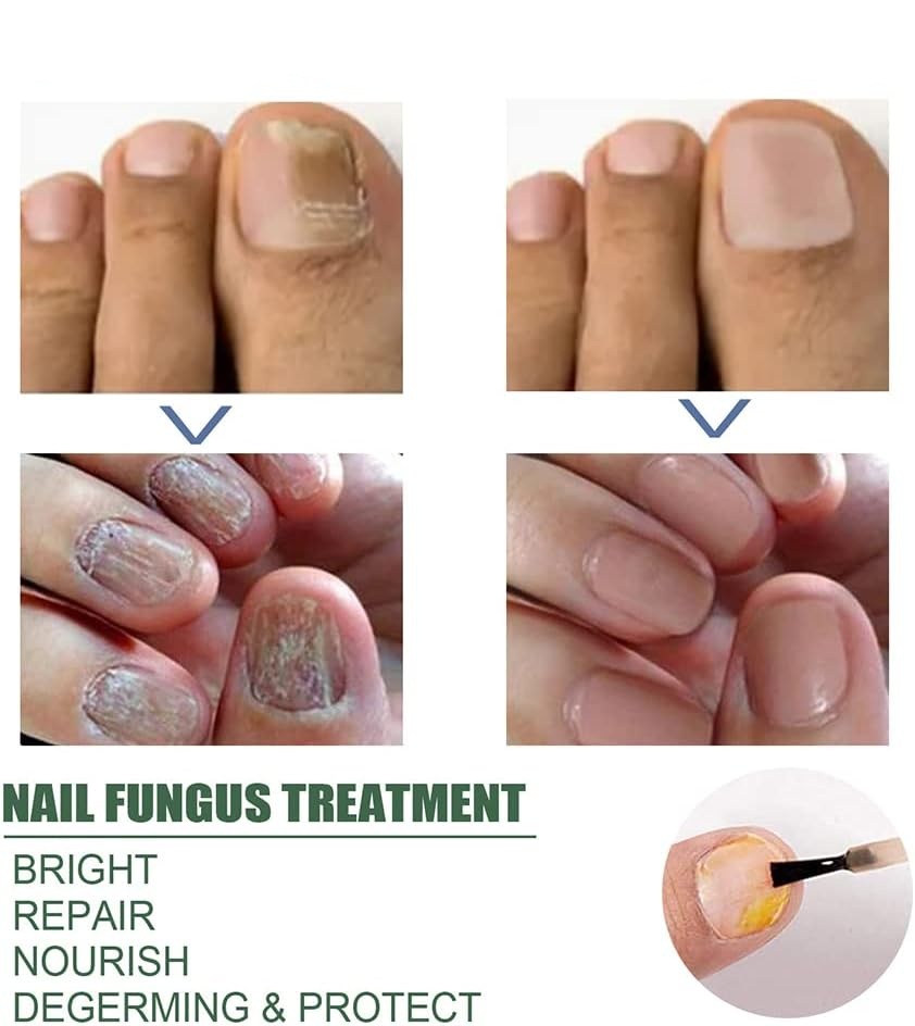 Sérum Soin des Ongles Fortifiant pour Ongles Cassants et Décolorés