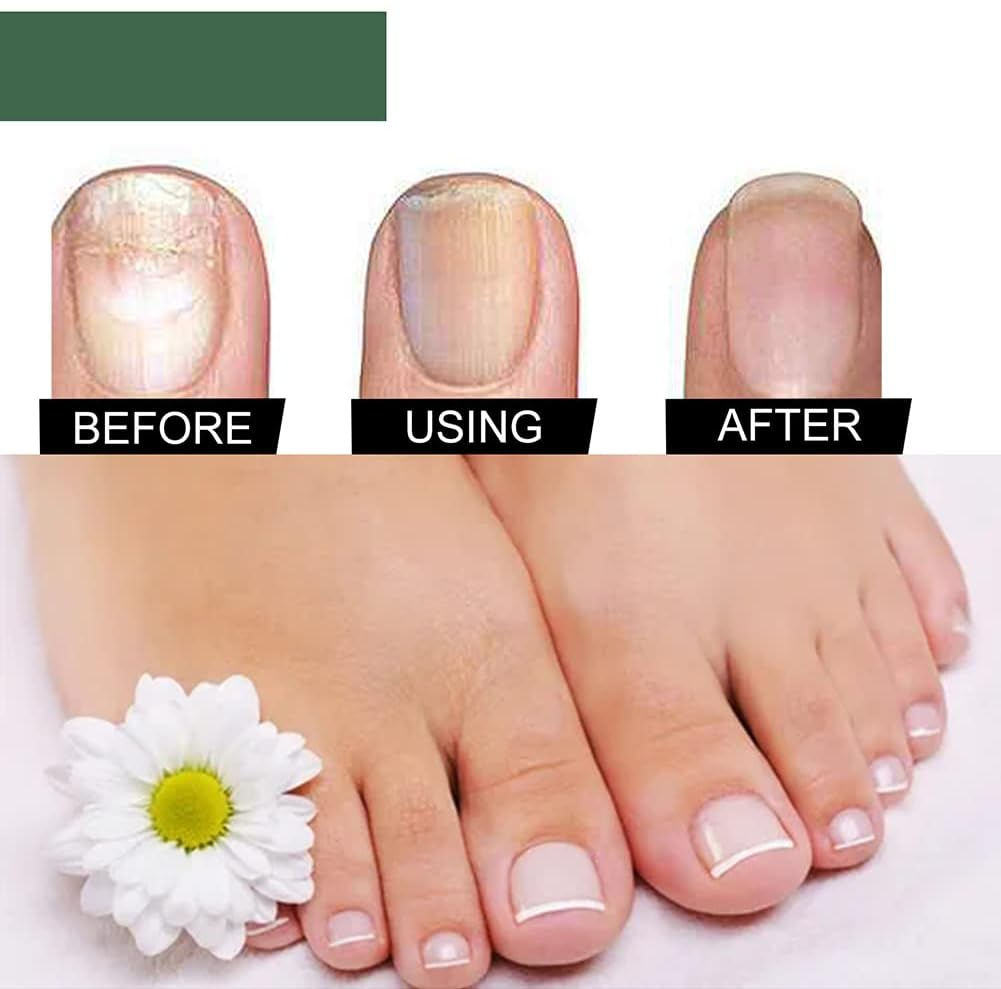 NagelPilz™ – Guérit, régénère et protège les ongles abîmés [1 + 1 Gratuit]