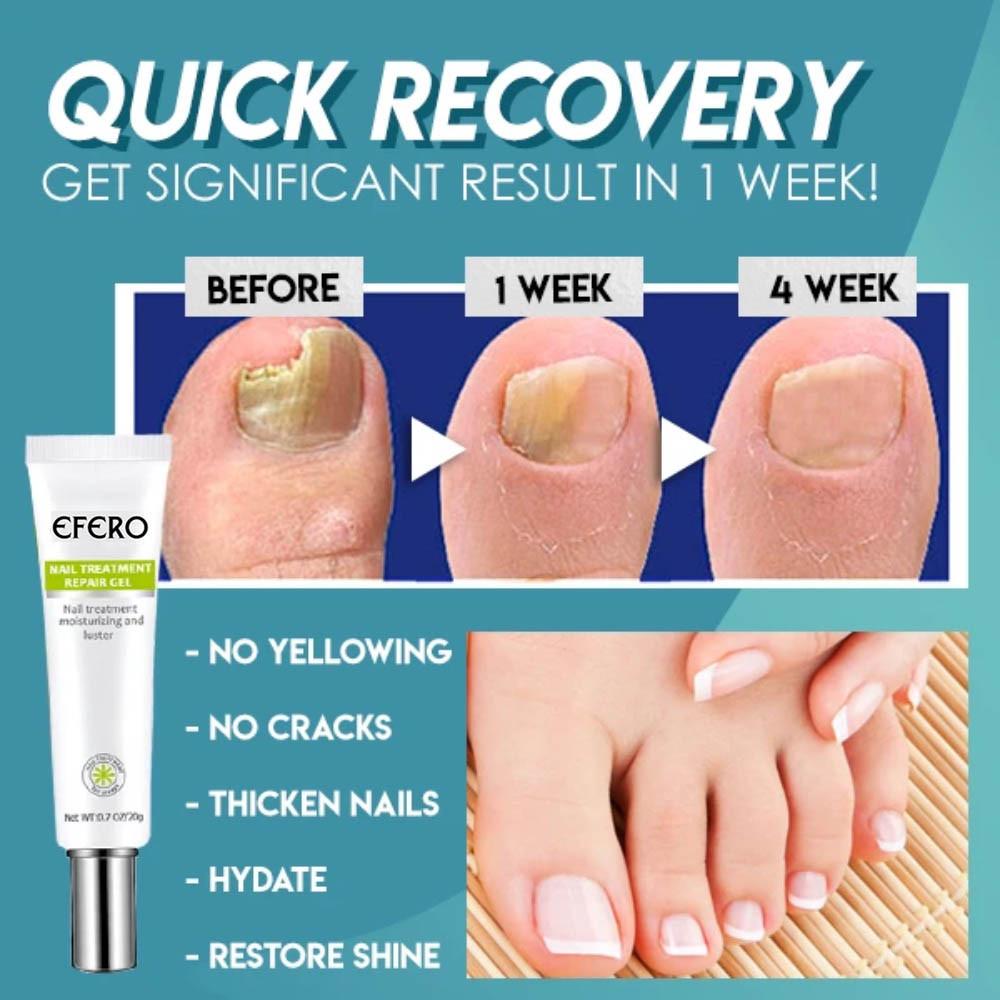 NailRepair™ – Résultats rapides, efficaces et durables [1 + 1 Gratuit]