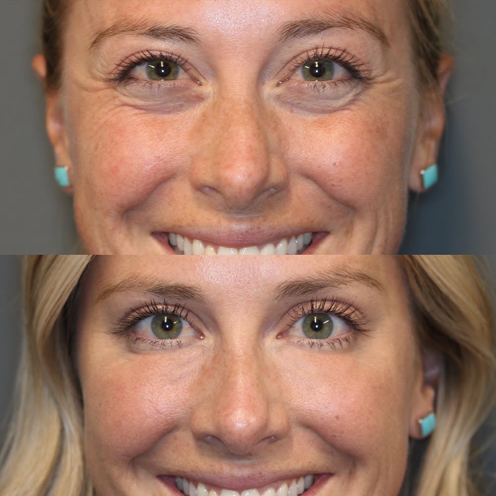 jugendlicherbalken™ – Pour un contour des yeux lisse, éclatant et d’apparence jeune [1 + 1 Gratuit]