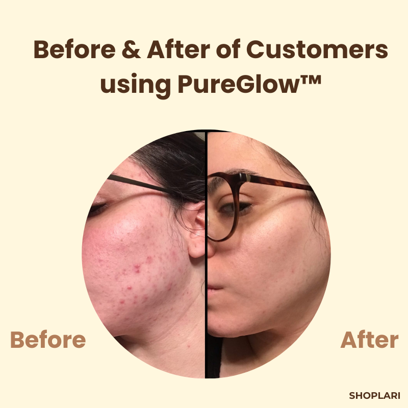 PureGlow™ – Peau claire et jeune qui inspire confiance [1 + 1 Gratuit]
