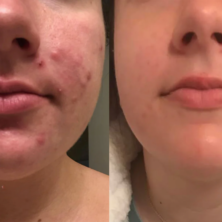 Dermiva™ – Bandes en silicone pour cicatrices efficaces [1 + 1 Gratuit]