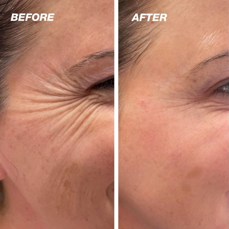 Dermiva™ – Bandes en silicone pour cicatrices efficaces [1 + 1 Gratuit]