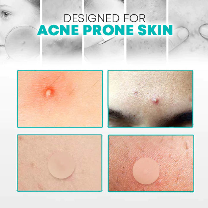 Pansements Anti-Acné à l'Hydrocolloïde et Acide Salicylique pour Peau Nette