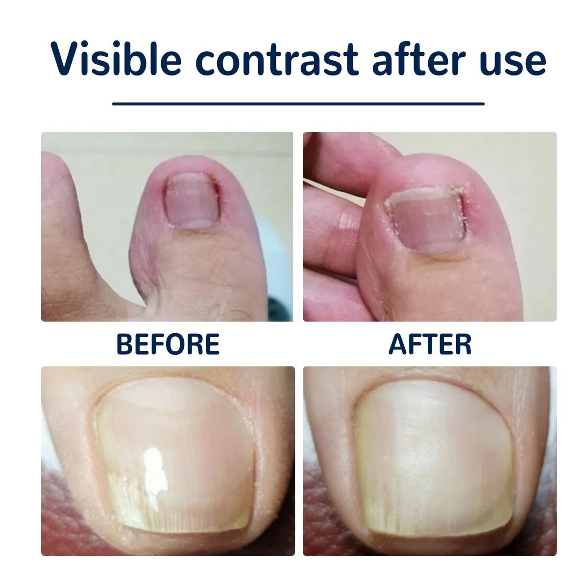 Coussinets Correcteurs pour Ongles Incarnés – Soin et Confort des Pieds