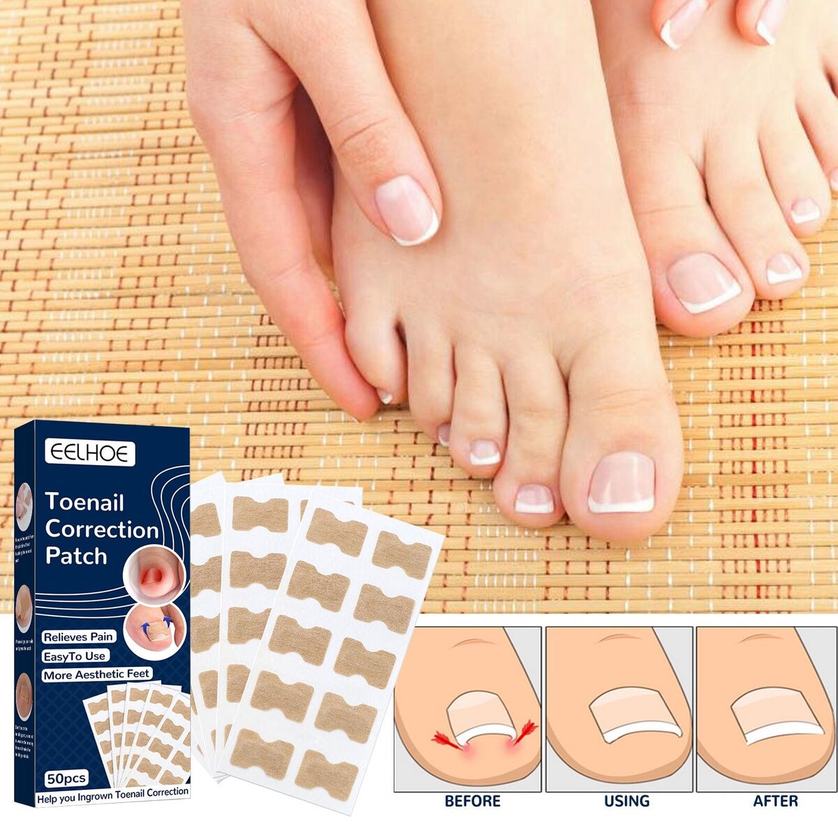 Coussinets Correcteurs pour Ongles Incarnés – Soin et Confort des Pieds