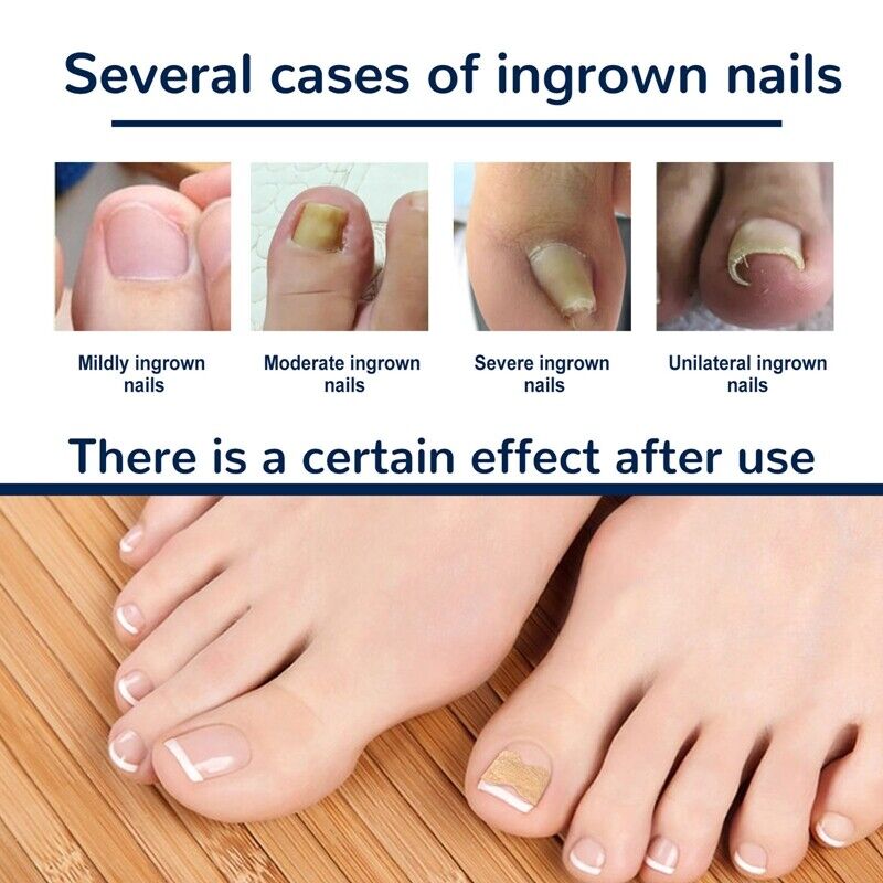 Coussinets Correcteurs pour Ongles Incarnés – Soin et Confort des Pieds