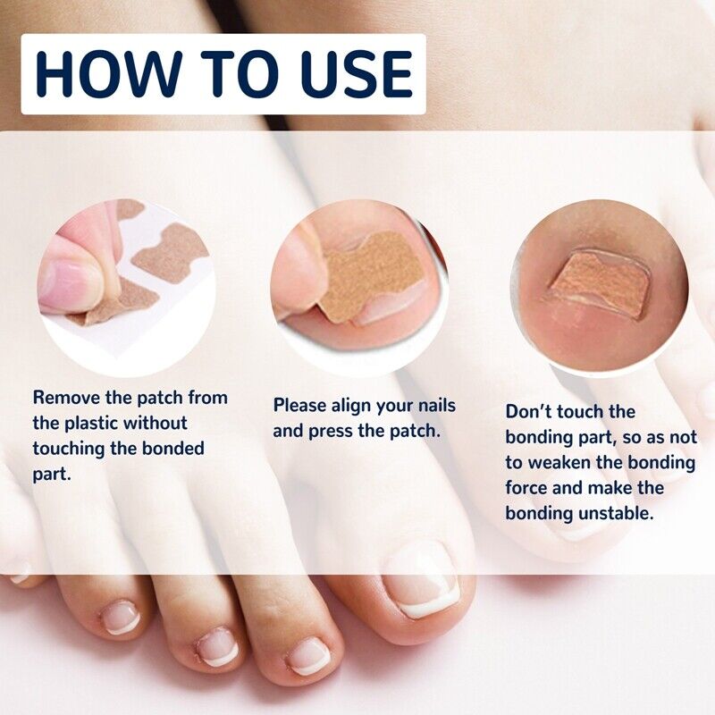 Coussinets Correcteurs pour Ongles Incarnés – Soin et Confort des Pieds
