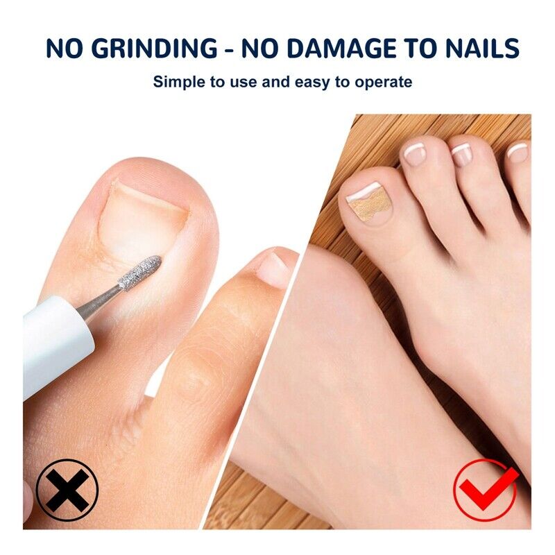 Coussinets Correcteurs pour Ongles Incarnés – Soin et Confort des Pieds