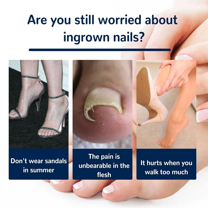 Coussinets Correcteurs pour Ongles Incarnés – Soin et Confort des Pieds