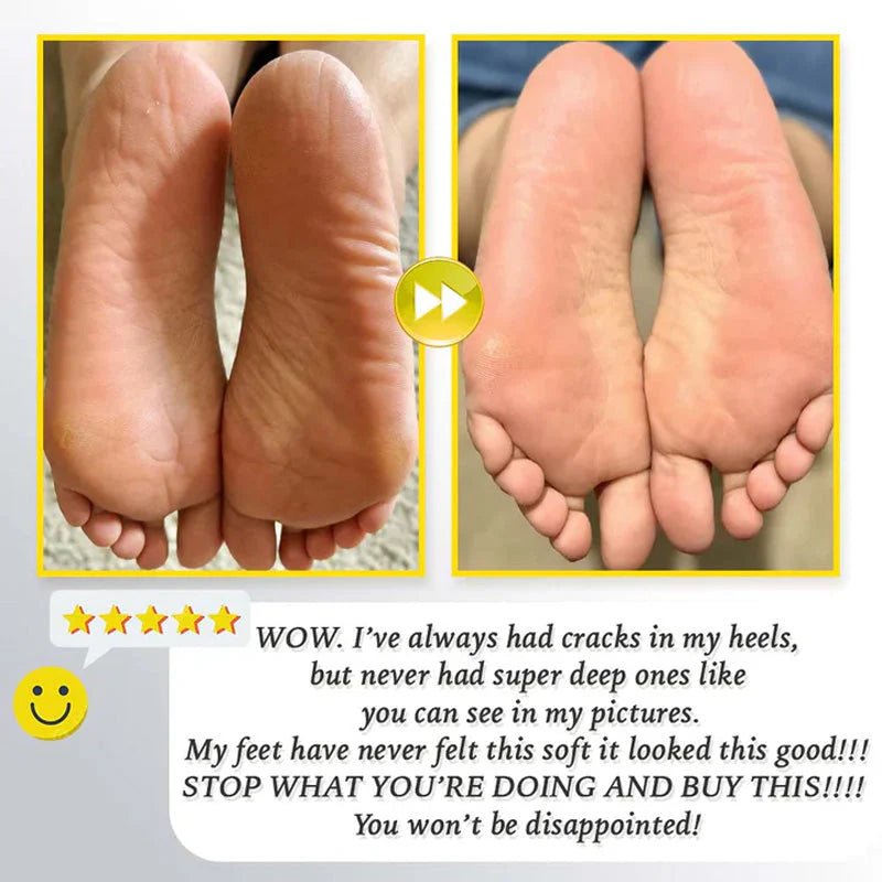 Gleam™ – Élimination douce des callosités pour des pieds lisses et soyeux [50 % de réduction]