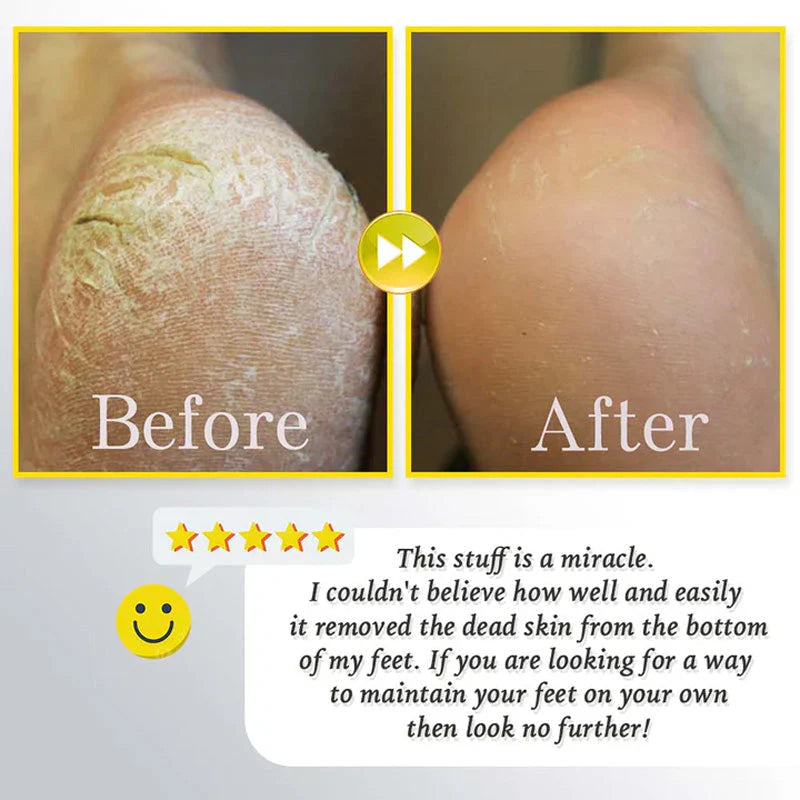 Gleam™ – Élimination douce des callosités pour des pieds lisses et soyeux [50 % de réduction]