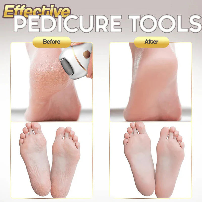 Gleam™ – Élimination douce des callosités pour des pieds lisses et soyeux [50 % de réduction]